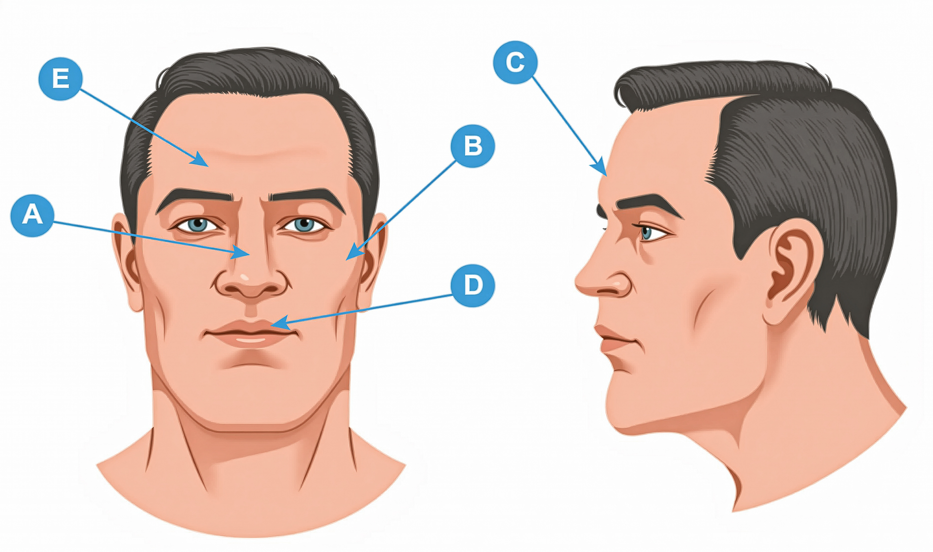 Figura 1: La nariz ensanchada, la frente abultada, los labios gruesos y las líneas faciales marcadas son señales típicas de acromegalia. Figura 1: La nariz ensanchada, la frente abultada, los labios gruesos y las líneas faciales marcadas son señales típicas de acromegalia.