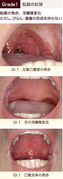 stomatitis_05.jpg