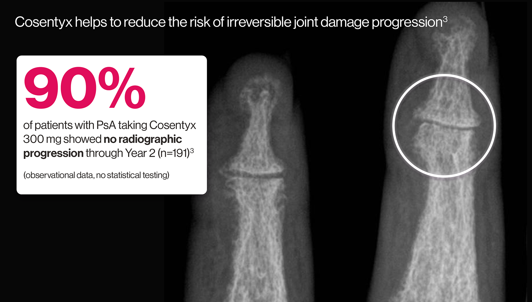 Artist's representation of early radiographic damage. Artist's representation of early radiographic damage.
